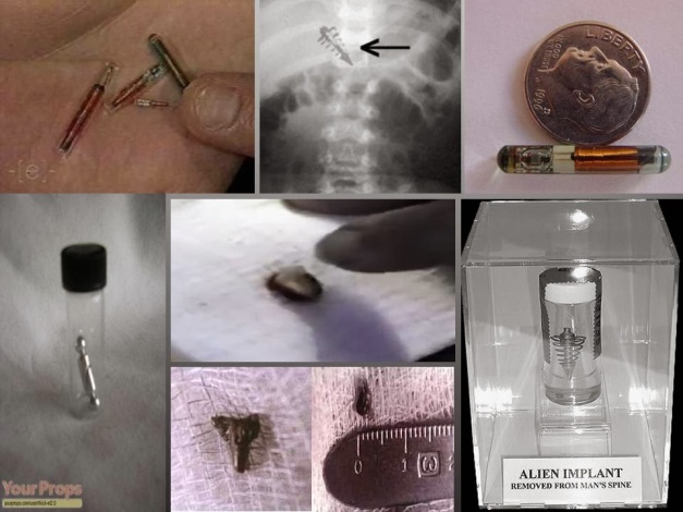 Análisis de supuestos implantes alienígenas encontrados 425fb-alienimplants